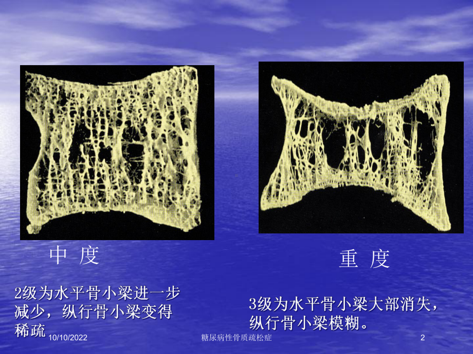 糖尿病性骨质疏松症培训课件.ppt_第2页