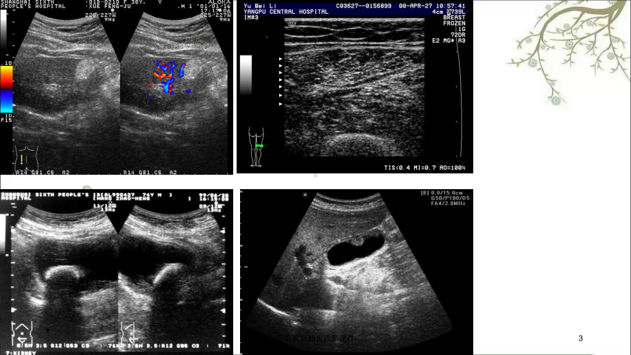 肝脏疾病超声诊断课件.ppt_第3页