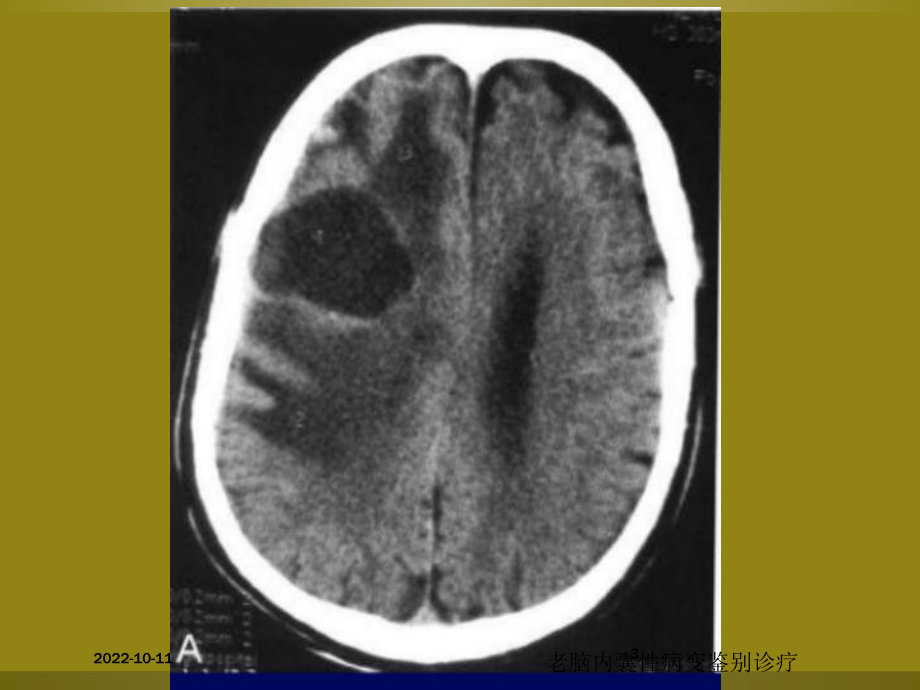 老脑内囊性病变鉴别诊疗培训课件.ppt_第3页
