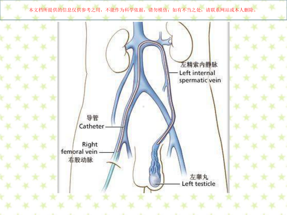 精索静脉曲张培训课件.ppt_第2页