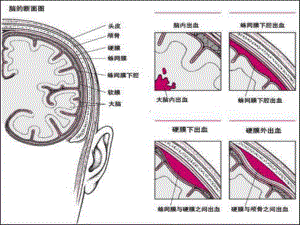 神经外科常见引流管的医疗护理培训课件.ppt