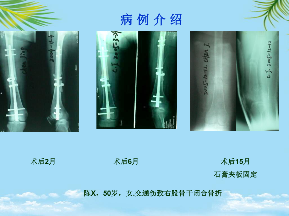 股骨干骨折不愈合的治疗概要课件.ppt_第2页