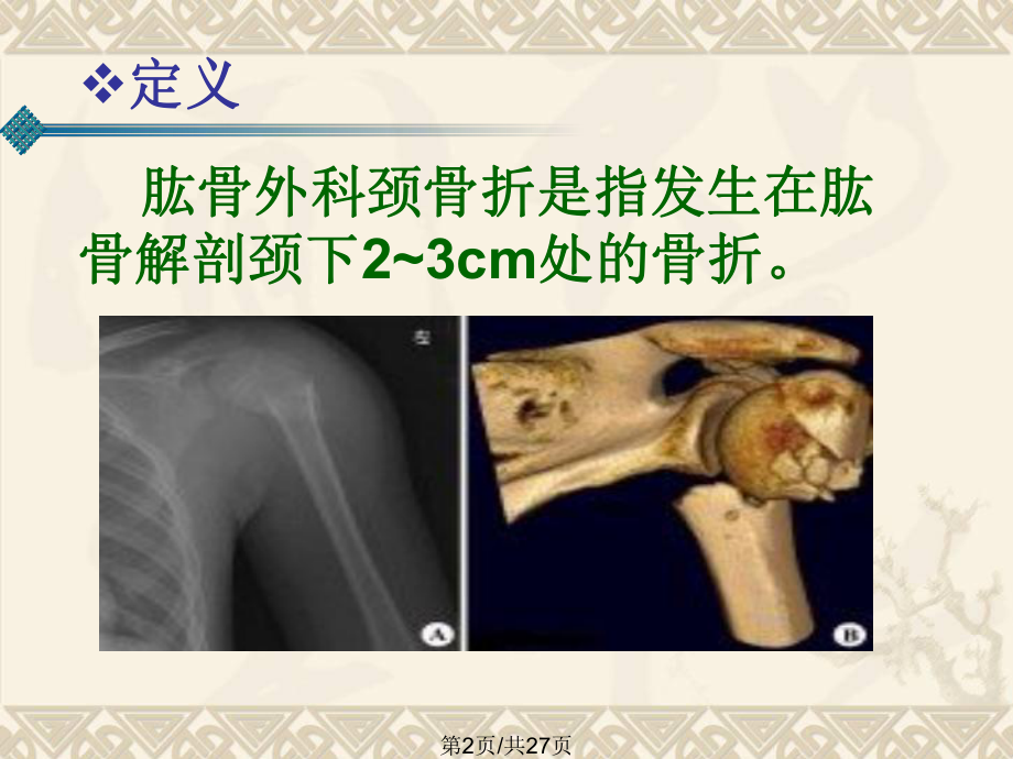 肱骨外科颈骨折全面版课件.pptx_第2页