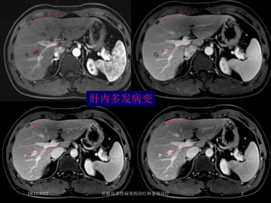 肝脏良恶性病变的诊疗和鉴别诊疗培训课件.ppt_第2页