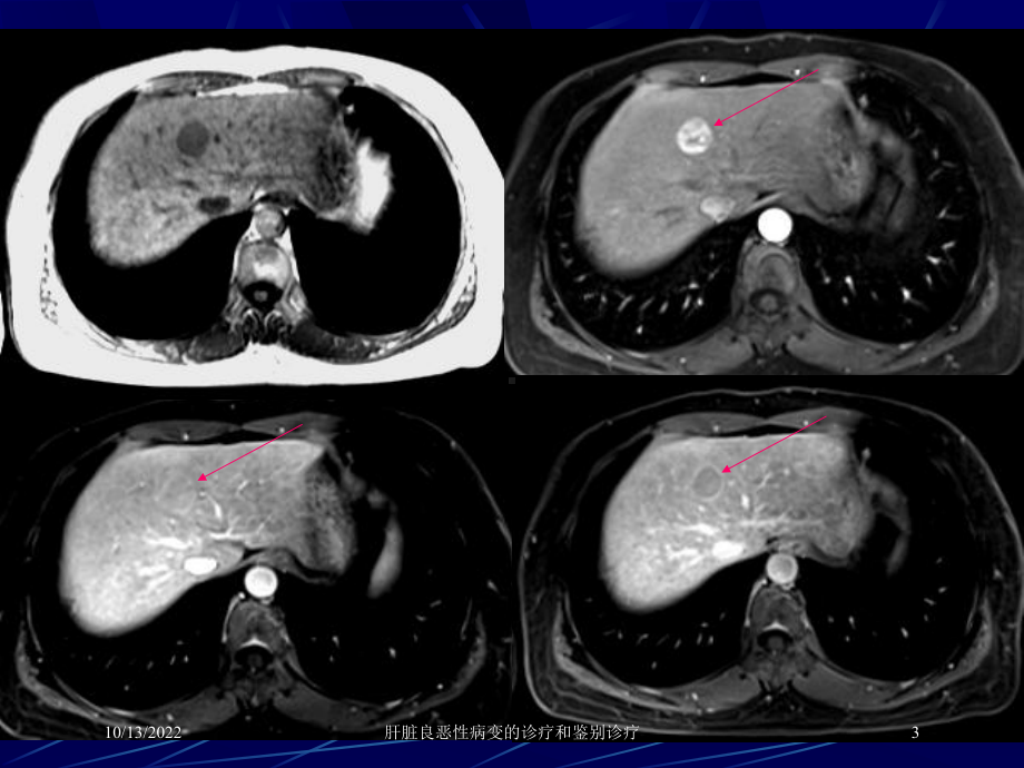 肝脏良恶性病变的诊疗和鉴别诊疗培训课件.ppt_第3页