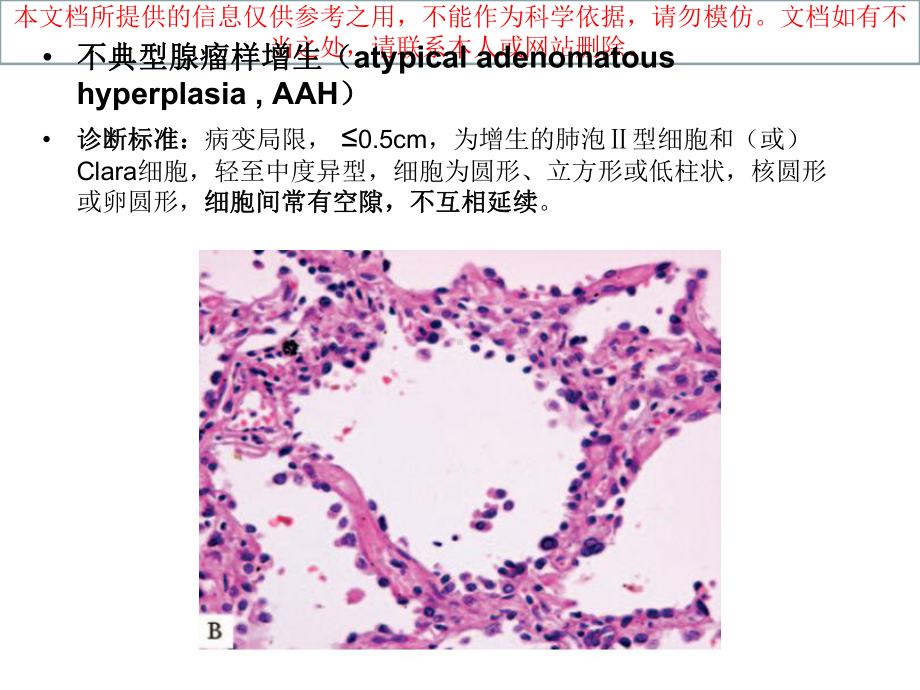 肺腺癌新分类培训课件.ppt_第3页