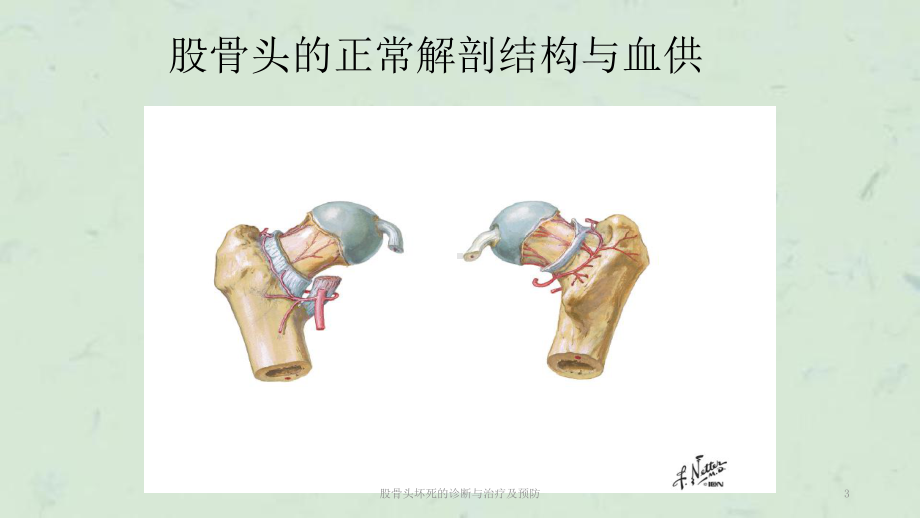 股骨头坏死的诊断与治疗及预防课件.ppt_第3页