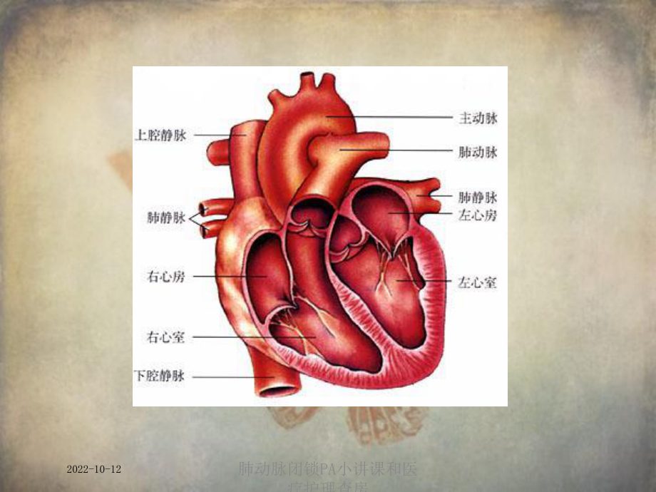 肺动脉闭锁PA小讲课和医疗护理查房培训课件.ppt_第2页