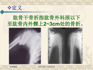 肱骨干骨折专业知识宣贯培训课件.ppt