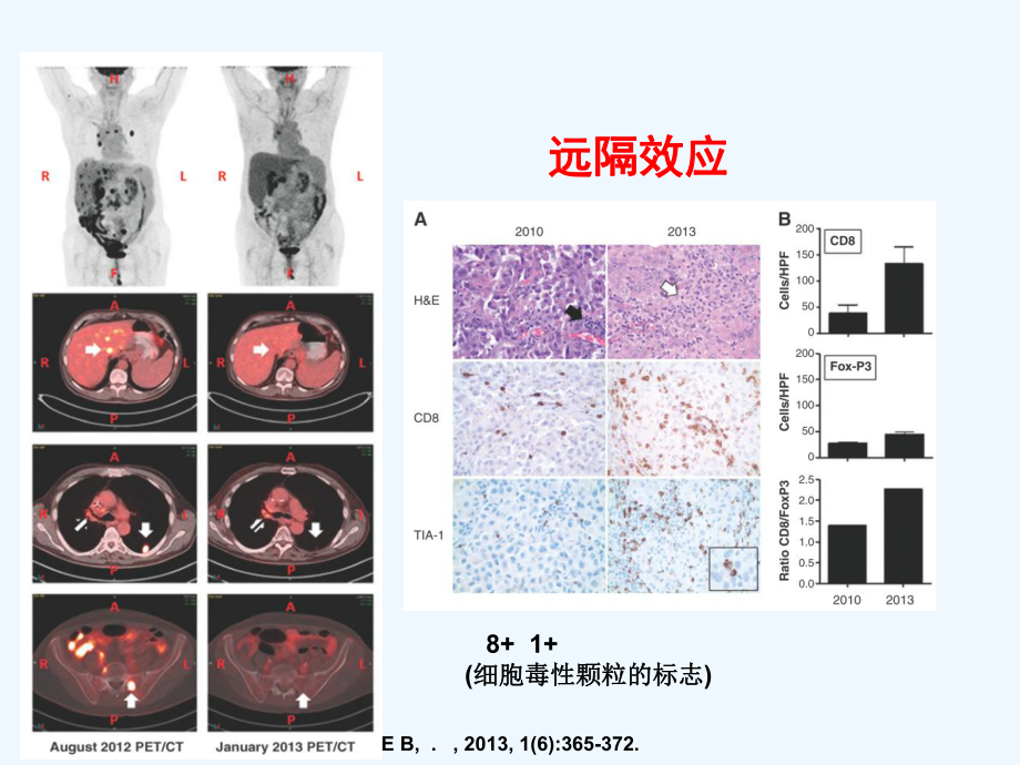 肺癌SBRT与免疫相关进展课件.ppt_第3页