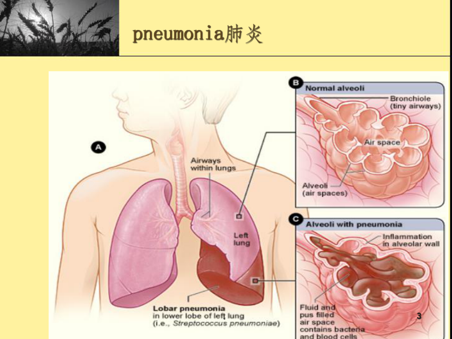 肺炎的护理(带案例)课件.ppt_第3页