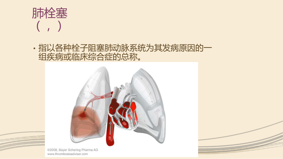 肺血栓栓塞症(PTE课件.pptx_第2页