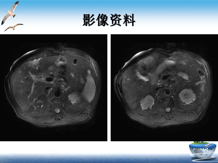 肝腺瘤膀胱癌肉瘤优质案例课件.ppt_第3页