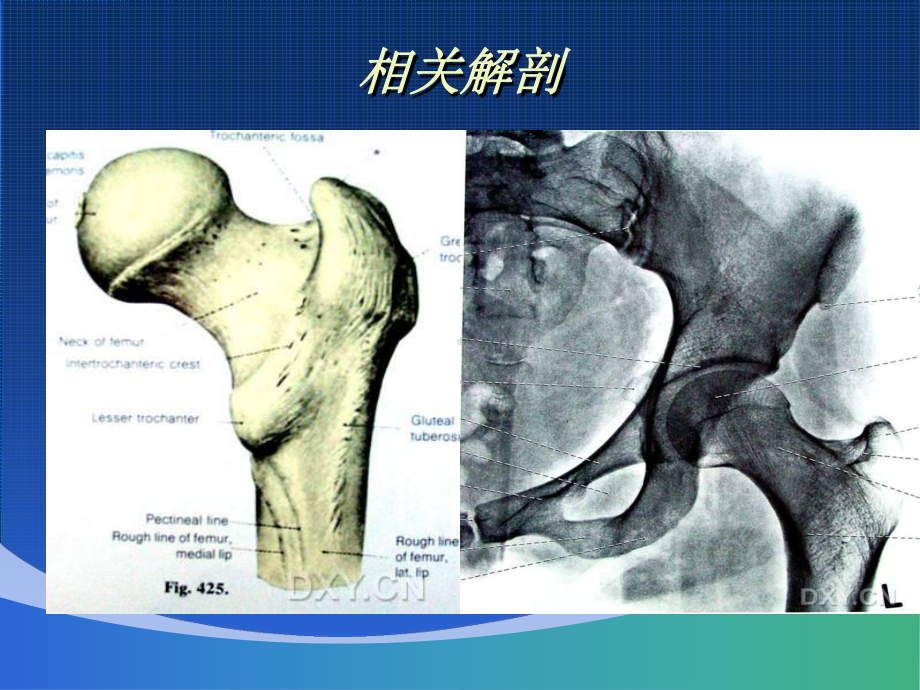 股骨粗隆间骨折的治疗课件.ppt_第3页