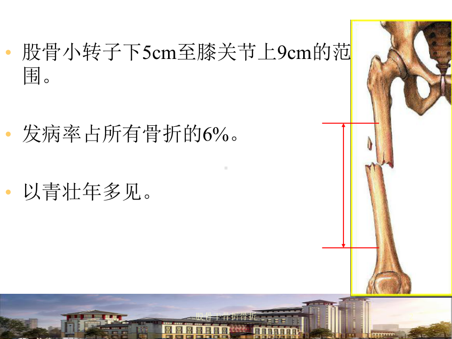 股骨干骨折骨折课件.ppt_第2页