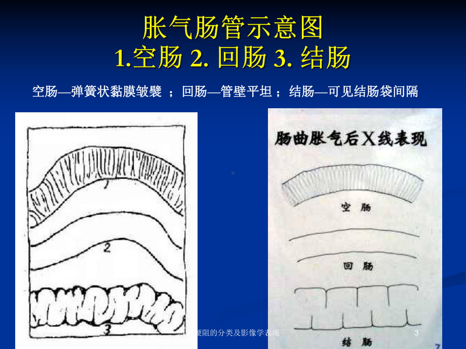 肠梗阻的分类及影像学表现培训课件.ppt_第3页