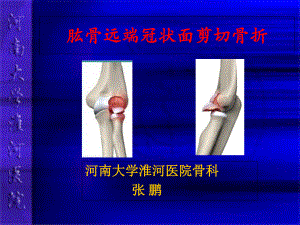 肱骨冠状剪切骨折课件.ppt