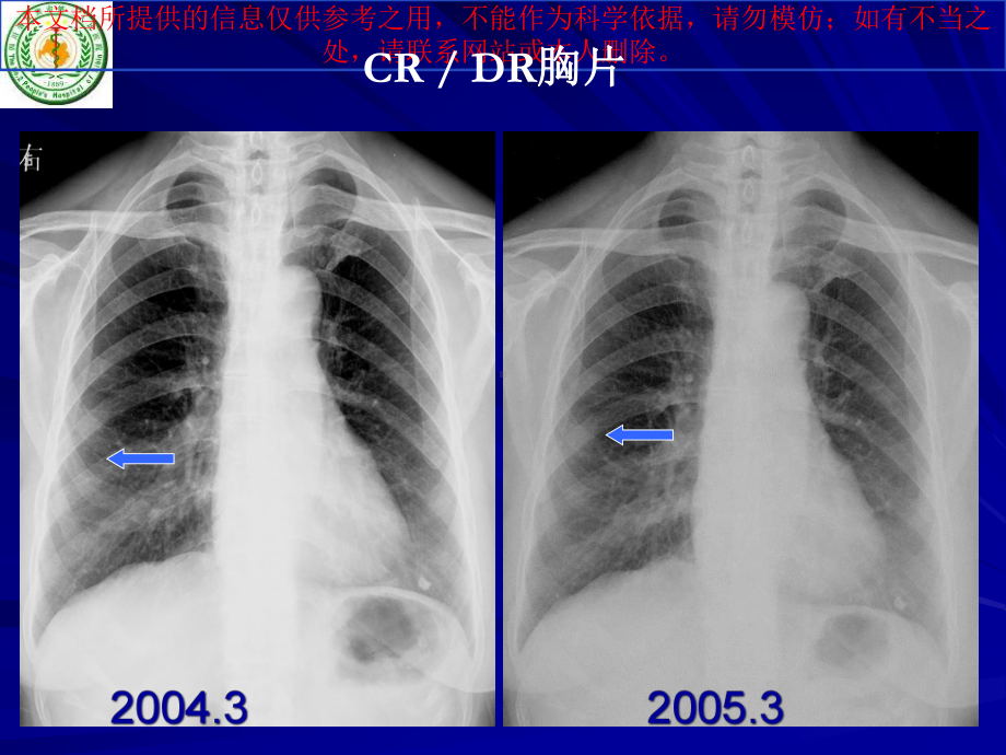 肺磨玻璃结节CT诊疗培训课件.ppt_第3页