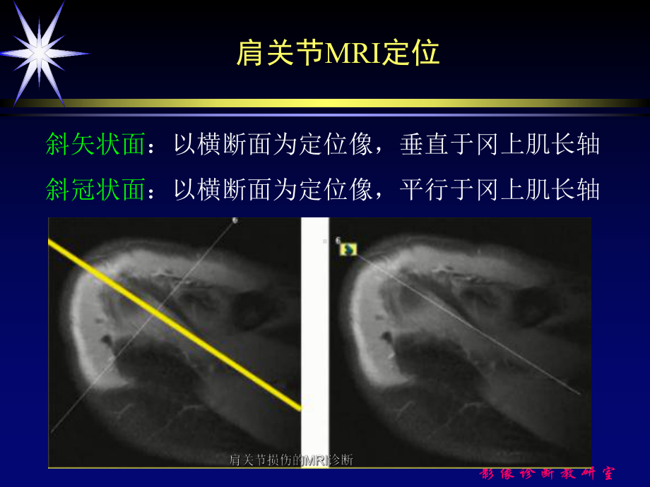 肩关节损伤的MRI诊断课件.ppt_第3页