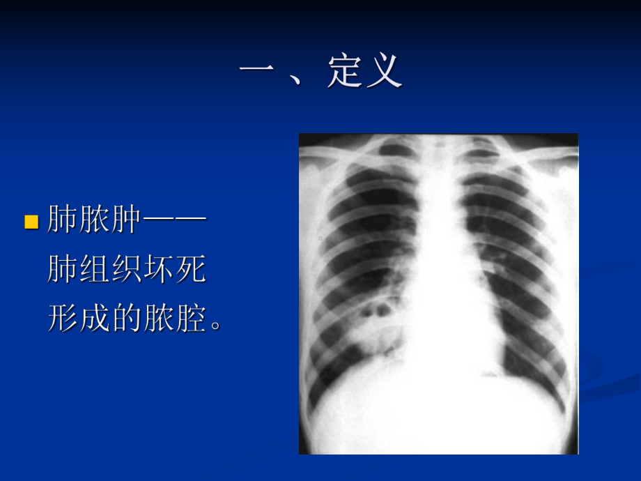 肺脓肿汇总专业医学知识宣讲讲义课件.ppt_第2页