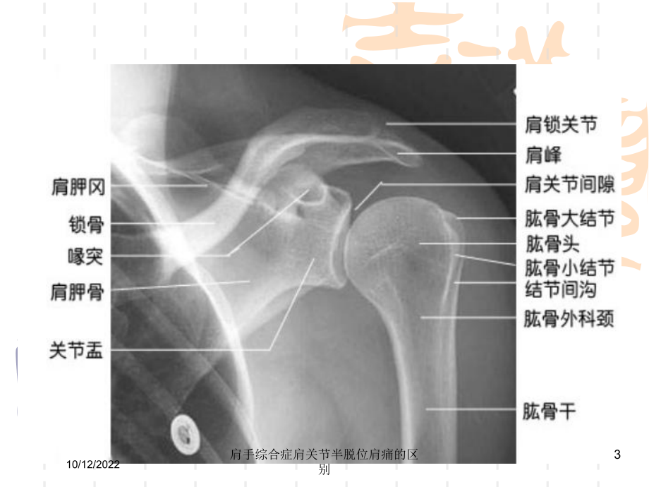 肩手综合症肩关节半脱位肩痛的区别培训课件.ppt_第3页