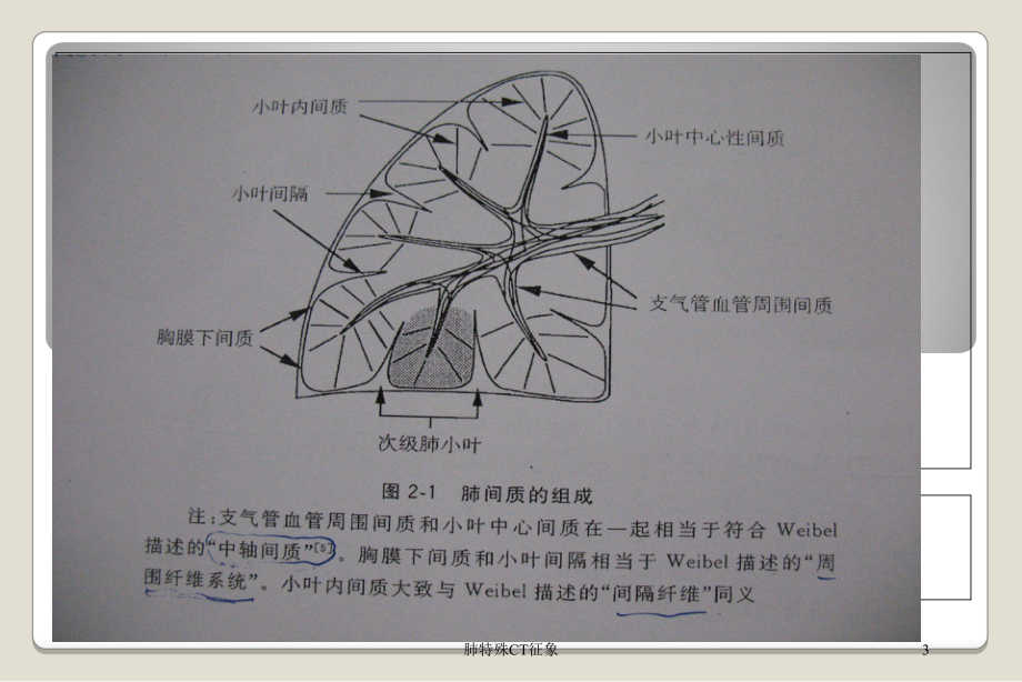 肺特殊CT征象培训课件.ppt_第3页