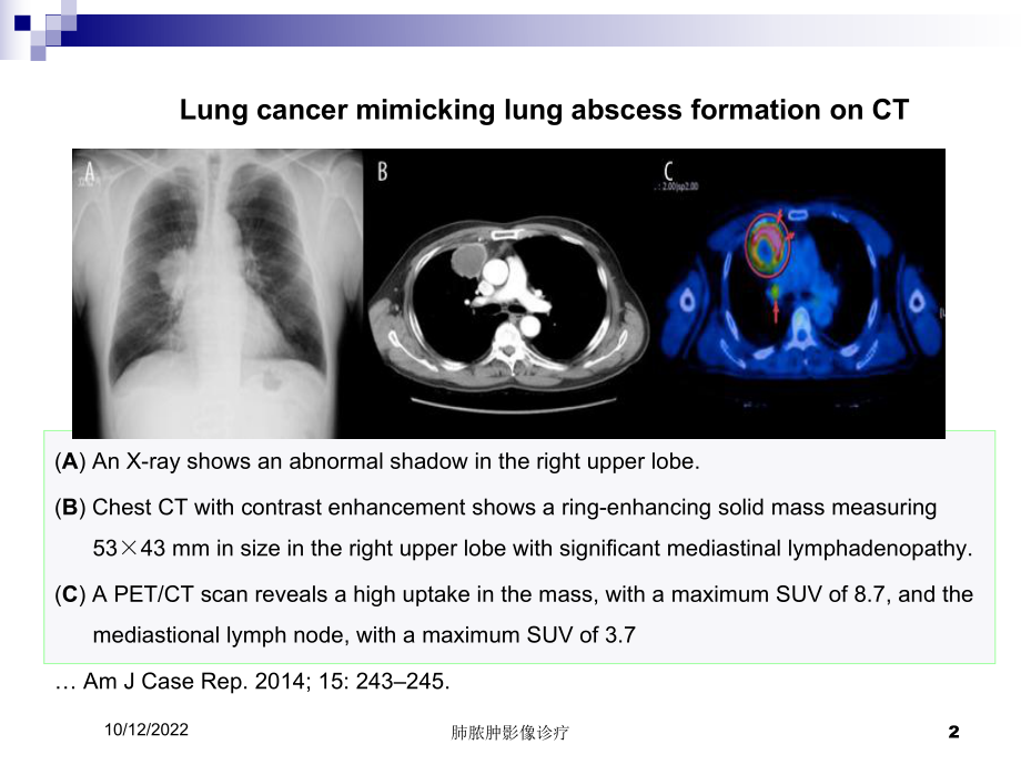 肺脓肿影像诊疗培训课件.ppt_第2页