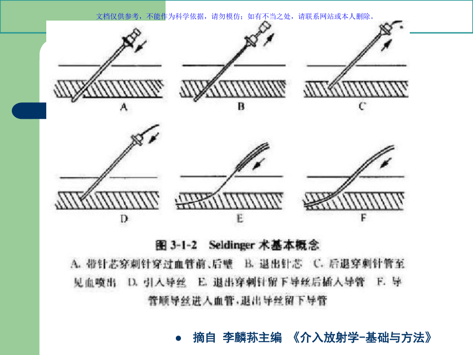 股动脉穿刺专题宣讲课件.ppt_第3页