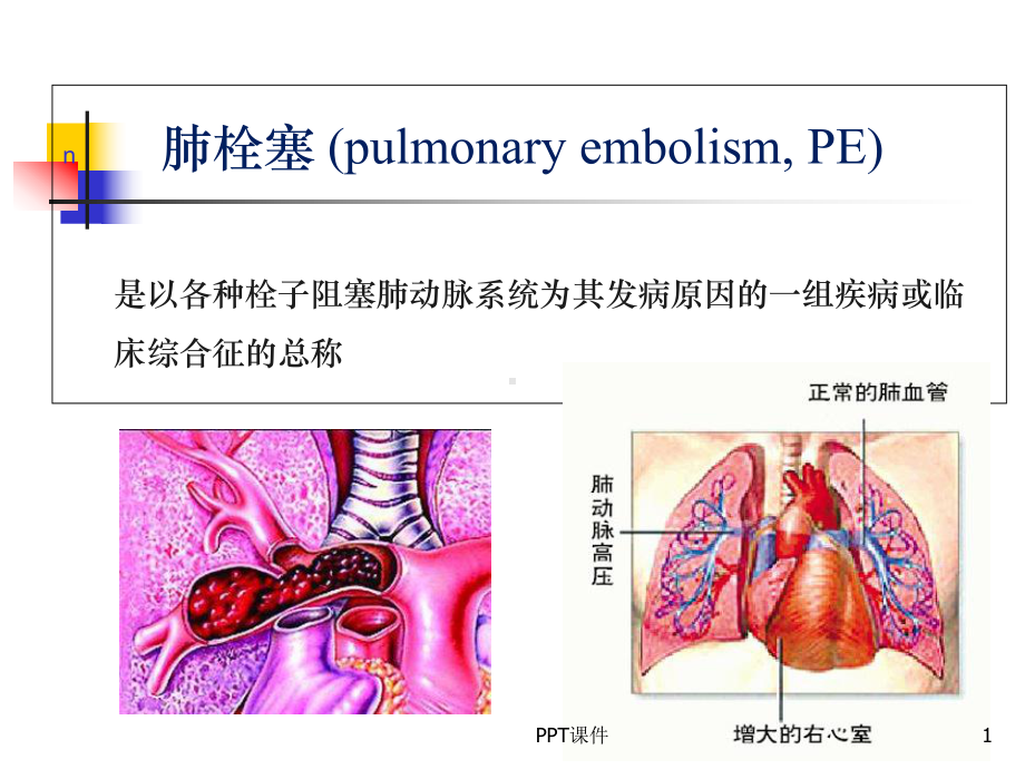 肺栓塞的发病机制诊断和处理-课件.ppt_第1页