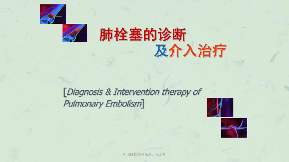 肺动脉栓塞诊断及介入治疗课件.ppt_第1页