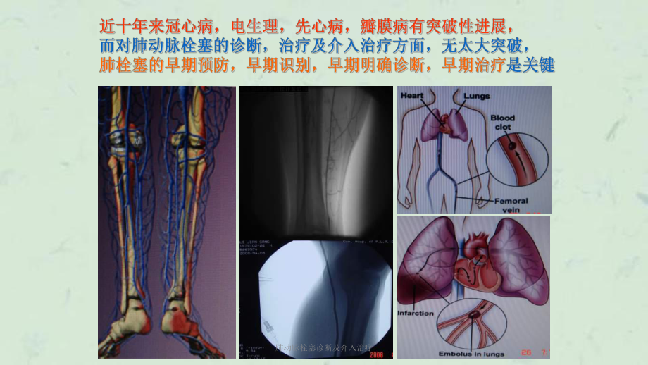 肺动脉栓塞诊断及介入治疗课件.ppt_第2页