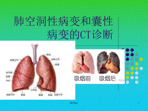 肺空洞性病变和囊性病变的CT诊断-课件.ppt