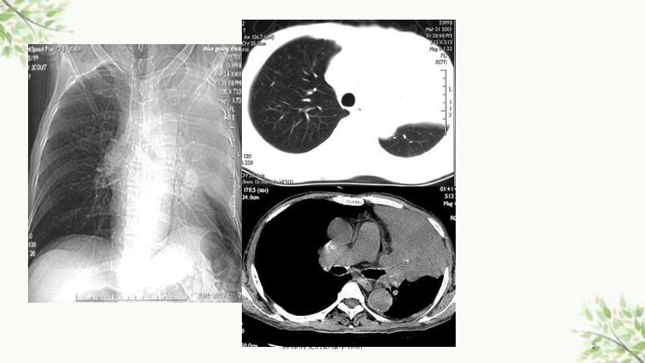 肺部病变的影像学诊断课件.ppt_第2页