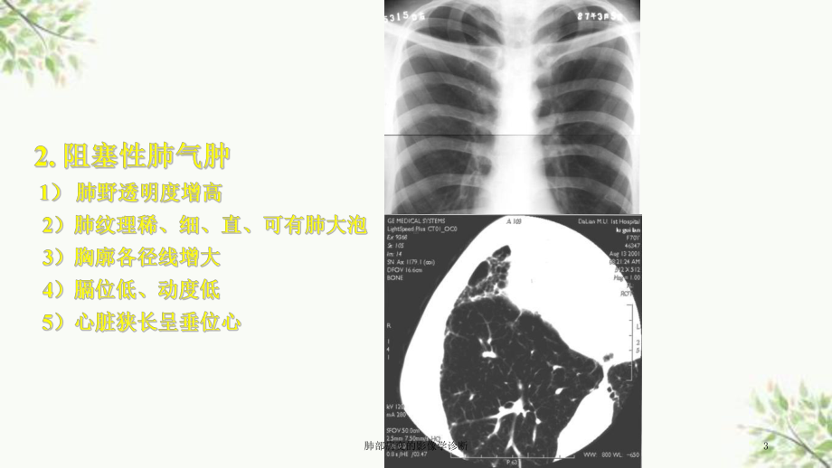 肺部病变的影像学诊断课件.ppt_第3页