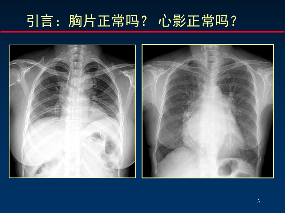 肺结核影像诊断与不典型征象鉴别课件.ppt_第3页