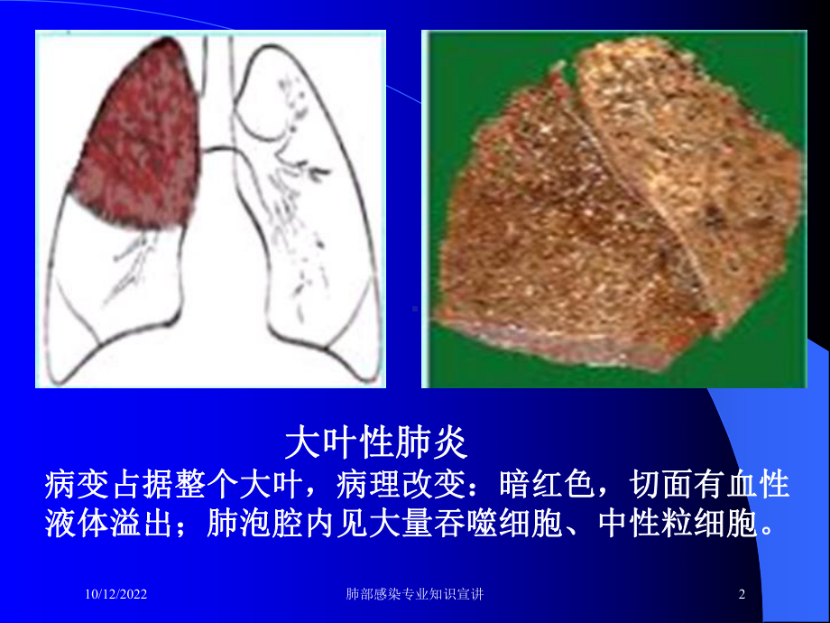 肺部感染专业知识宣讲培训课件.ppt_第2页