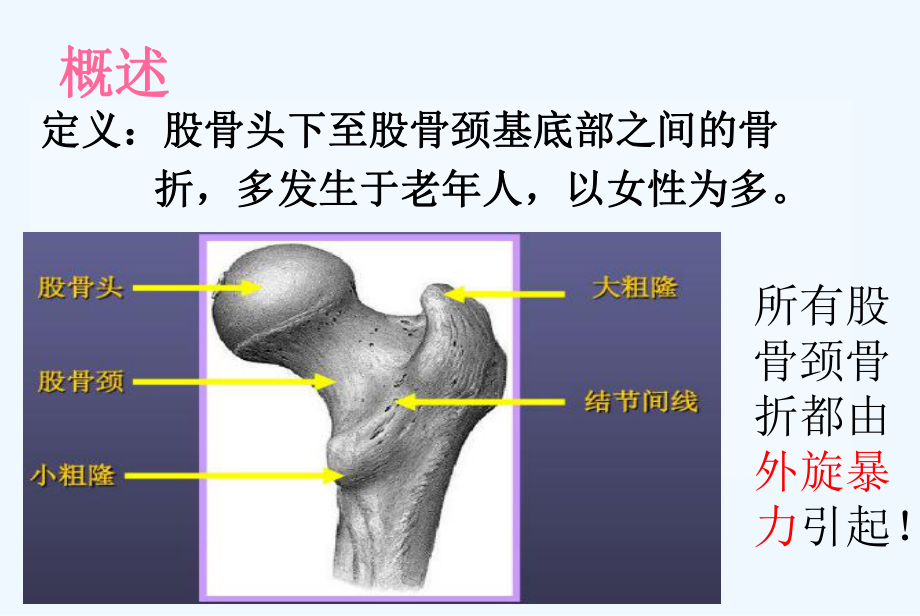 股骨颈骨折护理查房课件.ppt_第2页