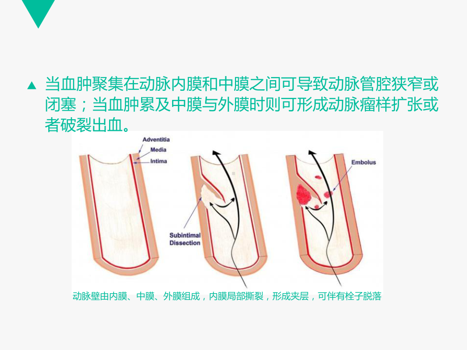 《颈动脉夹层》课件.ppt_第3页