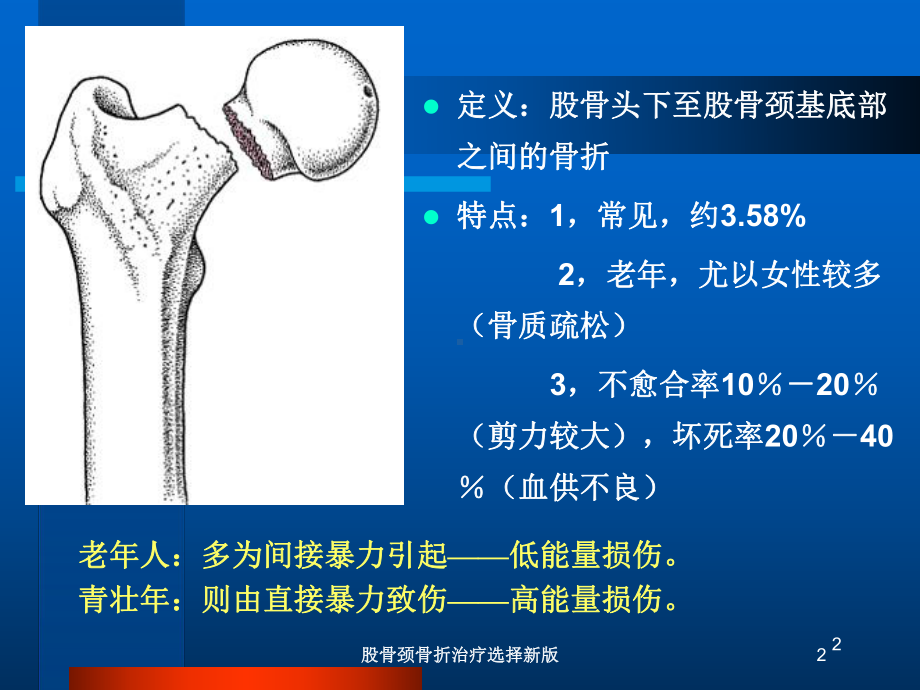 股骨颈骨折治疗选择新版培训课件.ppt_第2页