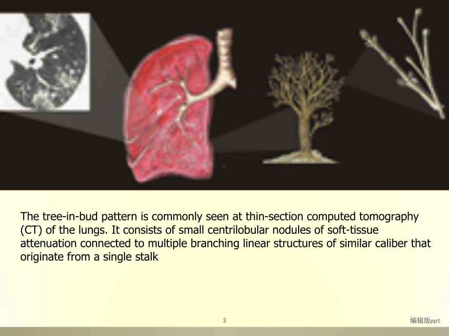 肺部CT树芽征的诊断价值课件.ppt_第3页