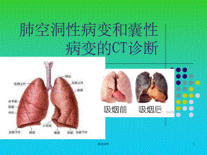 肺空洞性病变和囊性病变的CT诊断课件.ppt