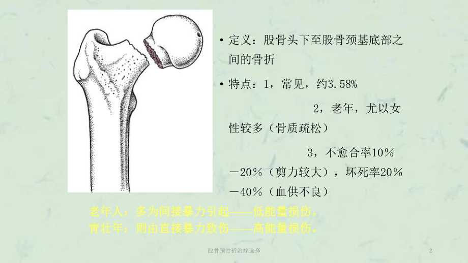 股骨颈骨折治疗选择课件.ppt_第2页