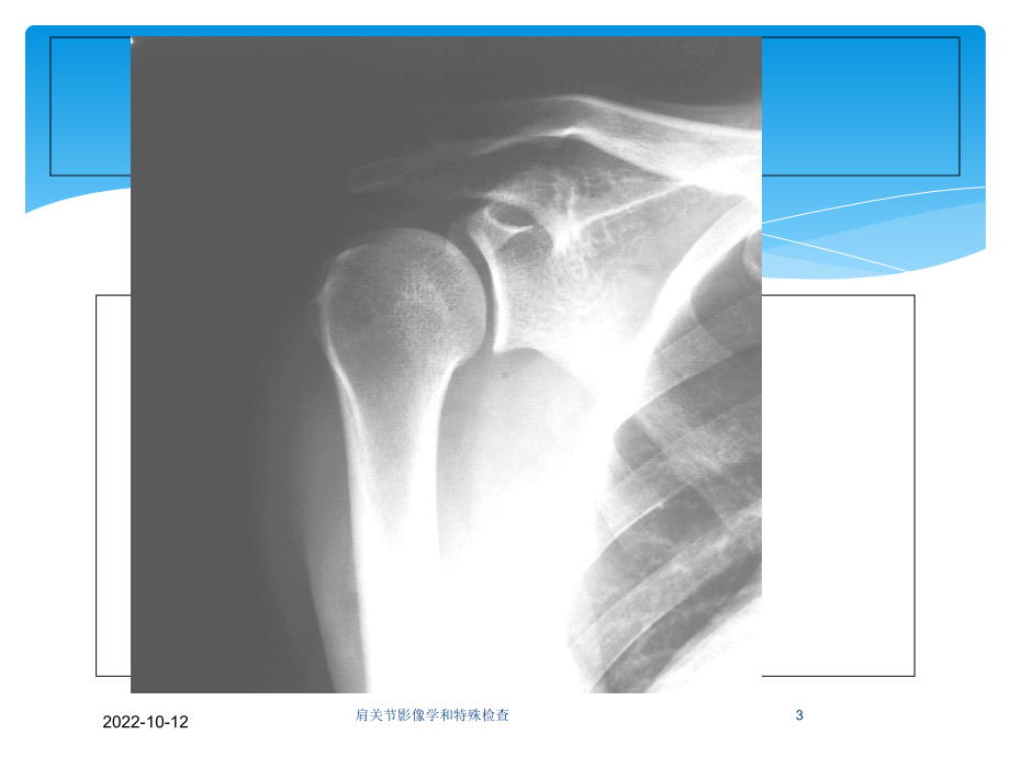 肩关节影像学和特殊检查培训课件.ppt_第3页