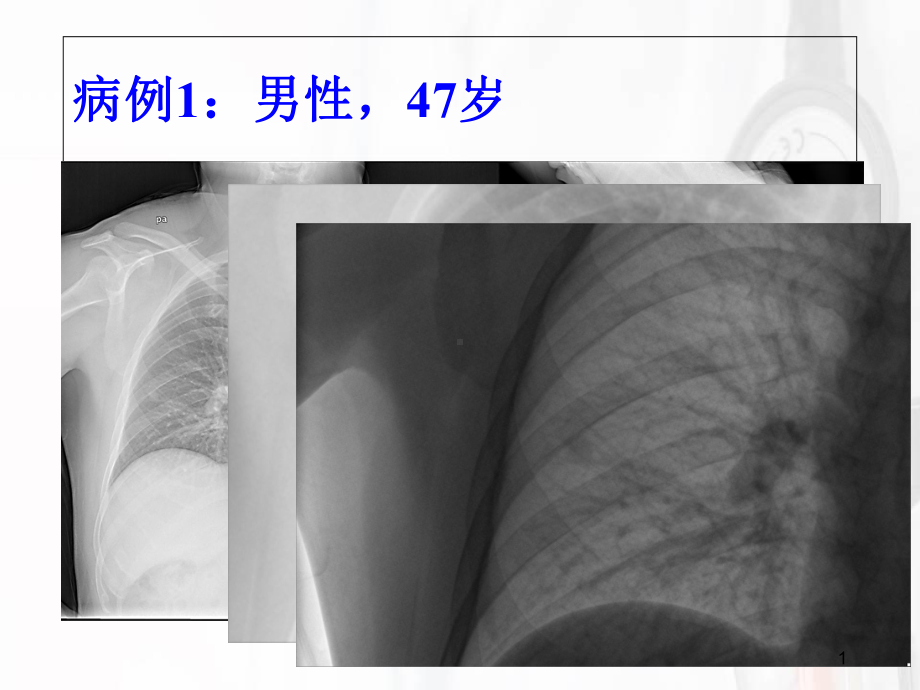 肺硬化性血管瘤影像学诊断学习课件.ppt_第1页