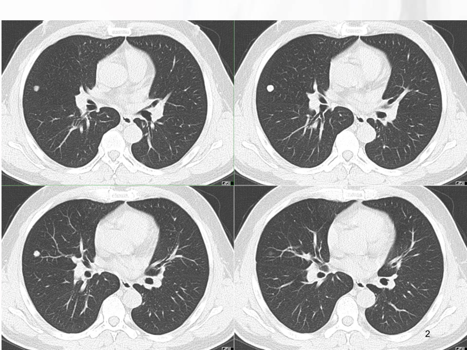 肺硬化性血管瘤影像学诊断学习课件.ppt_第2页