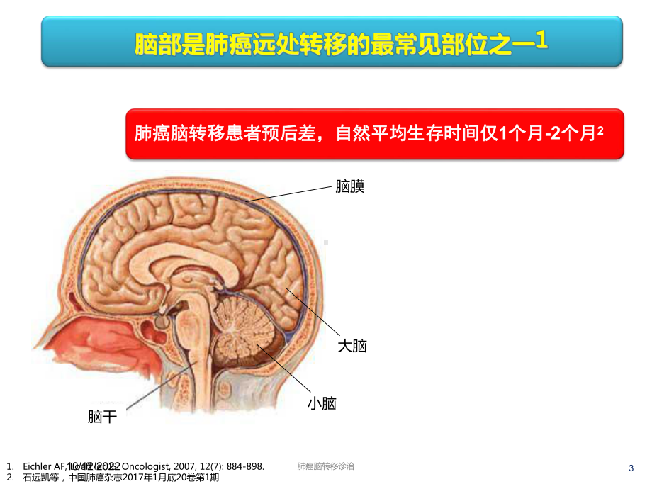 肺癌脑转移诊治培训课件.ppt_第3页