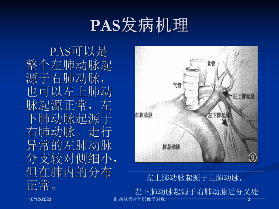 肺动脉吊带的影像学表现培训课件.ppt_第2页