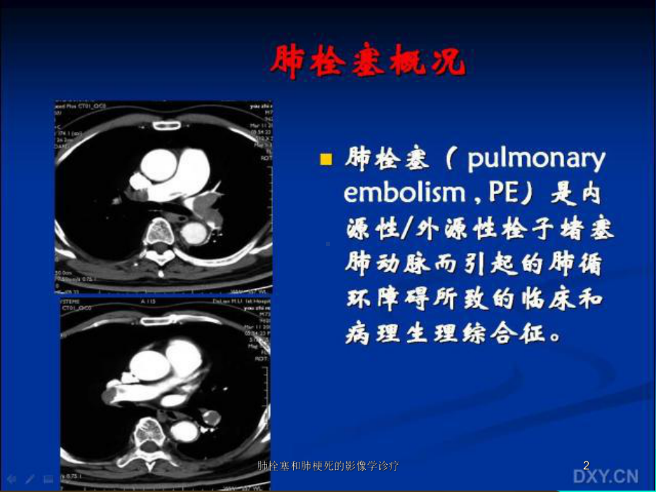 肺栓塞和肺梗死的影像学诊疗培训课件.ppt_第2页