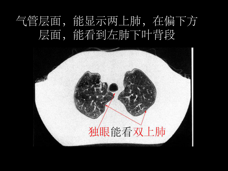 肺部CT分段课件.ppt_第1页