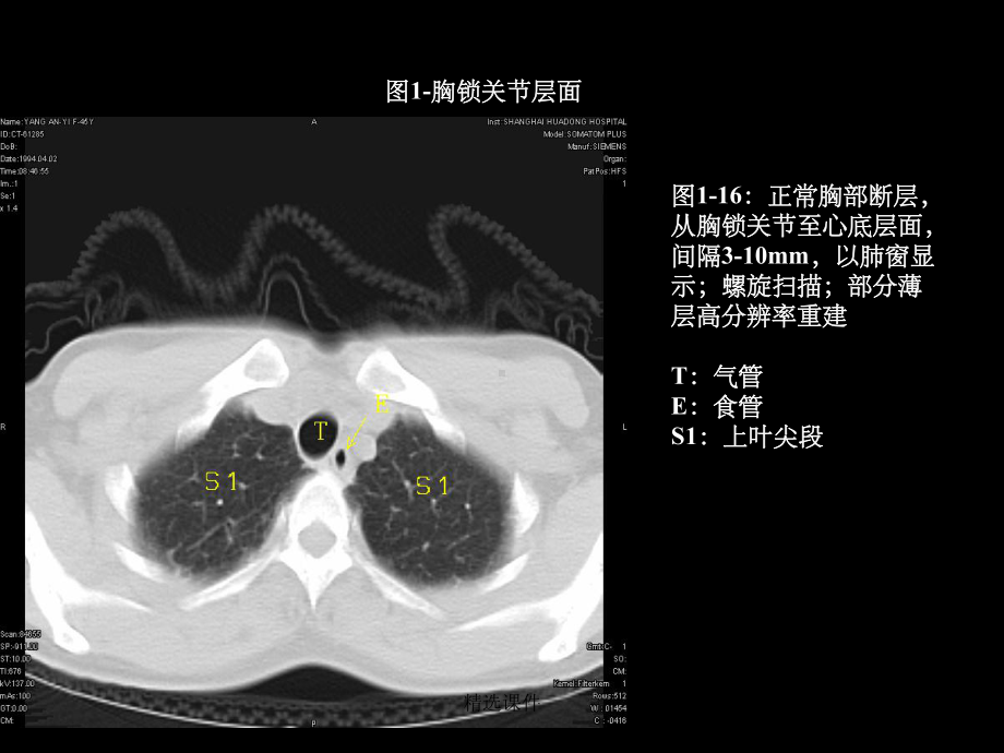 肺部CT分段课件.ppt_第3页